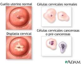 Displasia cervical.jpg