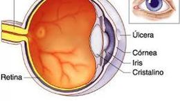 Ulceras e infecciones corneales.jpg