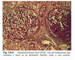 Glomerulosclerosis focal.JPG