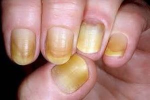Síndrome de uñas amarillas.jpeg