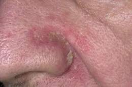 Dermatitis Varicosa.jpg