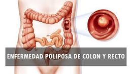 Lesiones polipoides de colon y recto.jpg