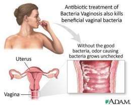 Bacterial-vaginosis-vaginitis.jpg