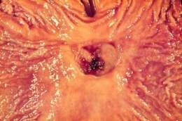 Ulcera gastrica.jpg