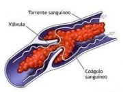 Vena con coágulo sanguíneo.