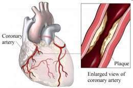 Síndrome coronario agudo 1480.jpg