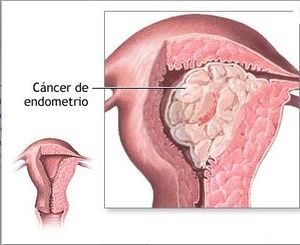 Adenocarcionoma de endometrio.JPG