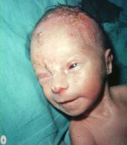 Herpes neonatal.jpg