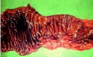 Enteritis Regional.JPG