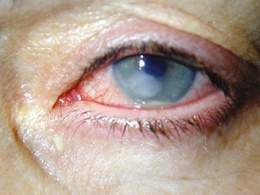 Lesion corneal.jpg