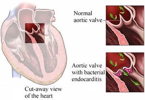 Endocarditis bacteriana.jpeg