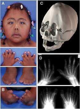 Sindrome de carpenter.jpg
