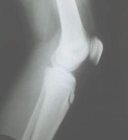 Radiografia Rx rodilla.jpg