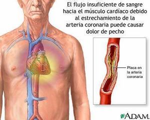 18054-angina-estable.jpg