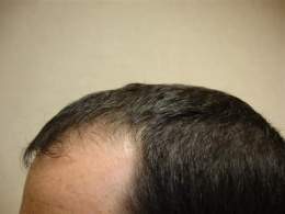 Alopecia idiopática 0134 (Small).jpg