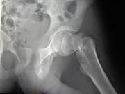 Hip fracture 343.jpg