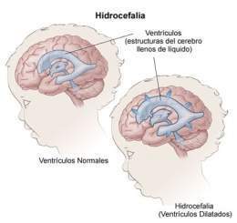 Hidrocefalia 2.jpg