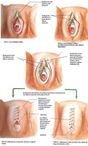Mutilación genital femenina.jpg