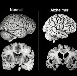 Diferencia de el cerebri de un alsaimer y una persona normal.jpg