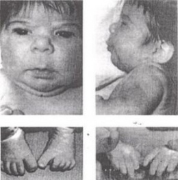 Síndrome del ácido valproico fetal.JPG