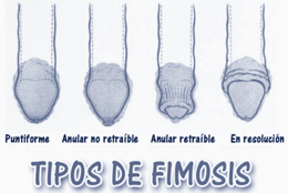Tipos de fimosis.png