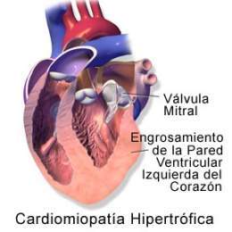 Cardiomiop hipert 2.jpg