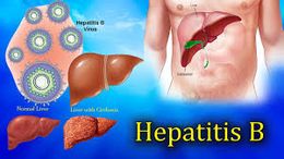 Infección crónica por el virus de la hepatitis B.jpg