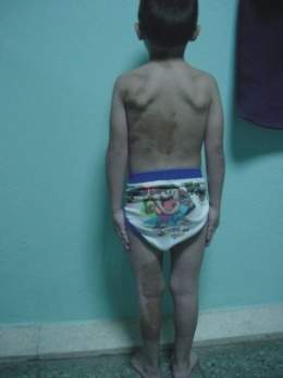 Síndrome de maccunne.jpg