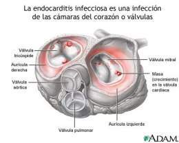 Endocarditis-infecciosa-18142.jpg