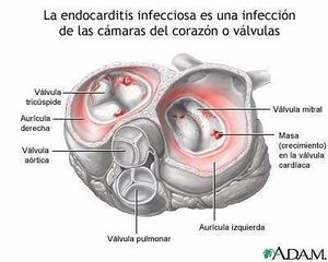 Endocarditis-infecciosa-18142.jpg