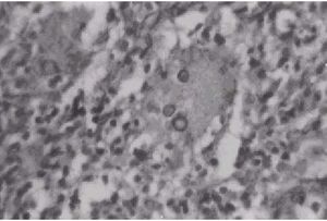 Cromoblastomicosisf0104101.jpg