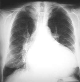 Miocardiopatia dilatada radiografia.jpg