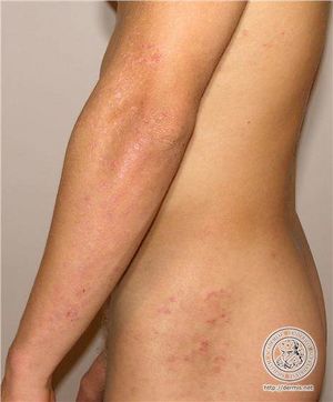 Dermatitis herpetiforme de Duhring.jpg