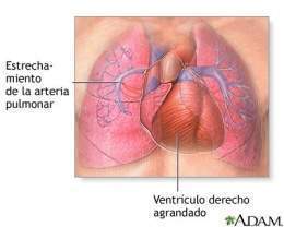 HTA-pulmon-prim 2.jpg
