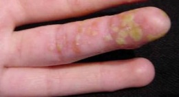 Psoriasis pustulosa.jpeg