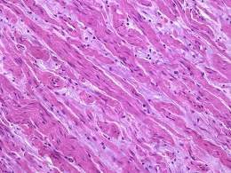 Adrenal Ganglioneuroma12.jpg