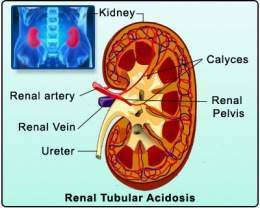 Renal-Tubular-Acidosis.jpg