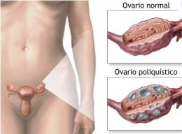 Sindromes ovaricos.JPG