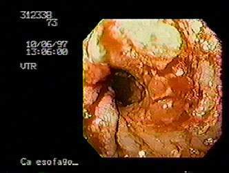 Archivo:Radiografía de esofago.jpg