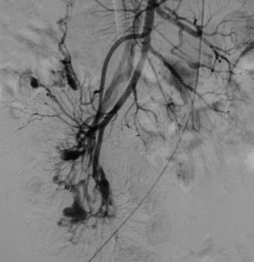 Angiodisplasia del colon EcuRed