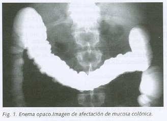Archivo:Colitis.gif