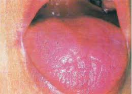 Glosoporosis.jpeg