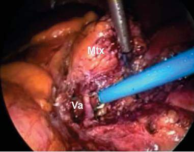 Archivo:Disección de una vena.jpg