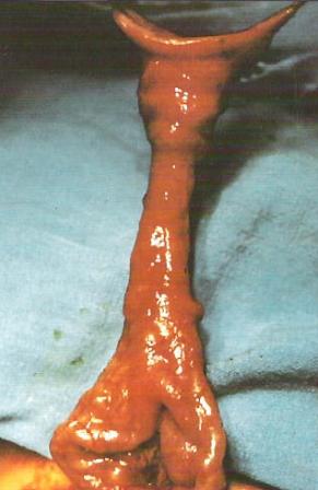 Fistula onfalomacenterica.JPG