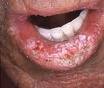Leucoplasia del labio.jpg