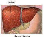 Quistes en el hígado.jpg