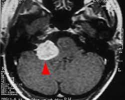 Tumores del Ángulo Ponto-Cerebeloso.jpg
