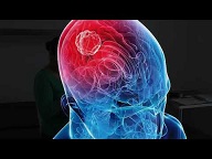 Tumor neural.jpg