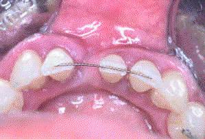 Férulas temporales.JPG