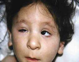 Síndrome de jorgenson lenz.jpg